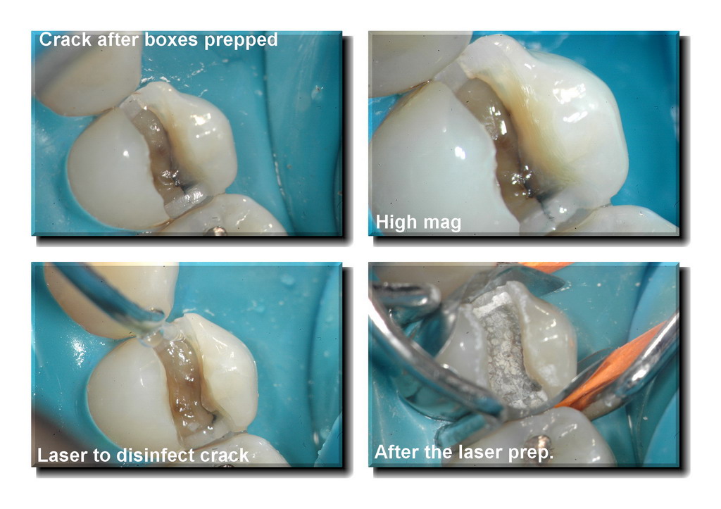 Cracked tooth pg 3_resize.jpg